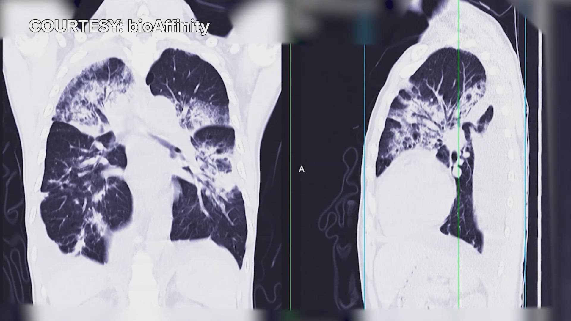 Lung cancer is the leading cause of cancer related deaths worldwide, often undiagnosed until it reaches advanced stage. That's why early detection is key.