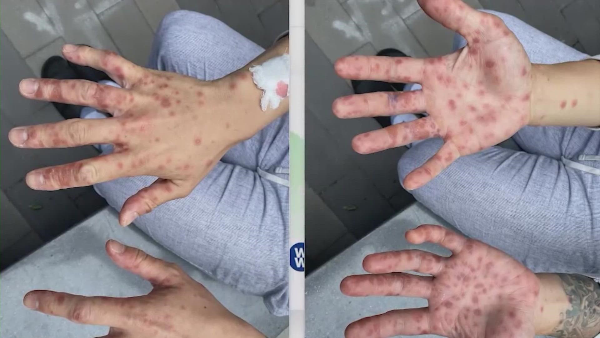 The disease, which can cause a serious skin rash, appears to be spreading largely via direct contact with the skin or saliva of an infected person.