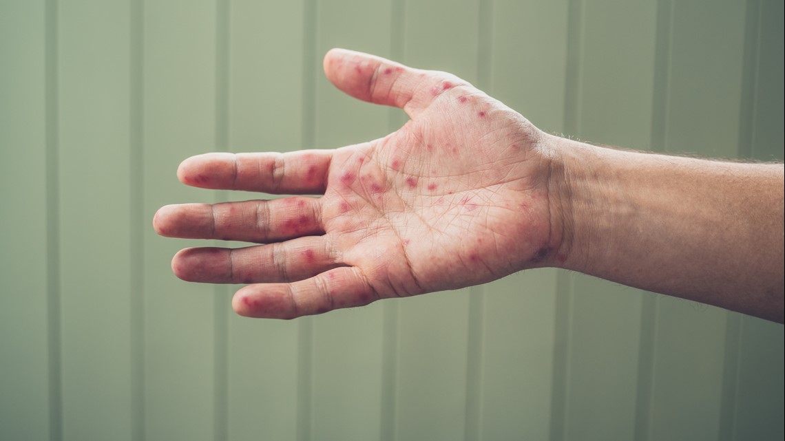 San Antonio Gas Prices >> Hand, foot and mouth disease spreading among SA children ... San Antonio Gas Prices >> Hand, foot and mouth disease spreading among SA children ...