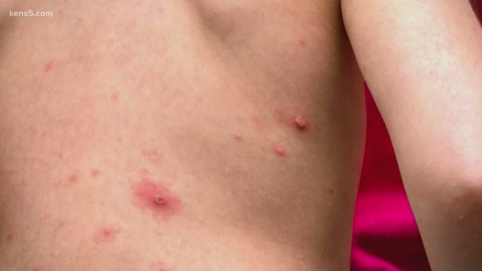 21 states, including Texas, have reported measles infections in 2018. So far, more than 100 people have contracted measles. Most of the patients were not vaccinated. Eyewitness News reporter Jeremy Baker has more.