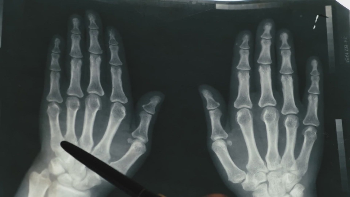 1 in 4 people have arthritis, and many don't do anything about it - Vimarsana News