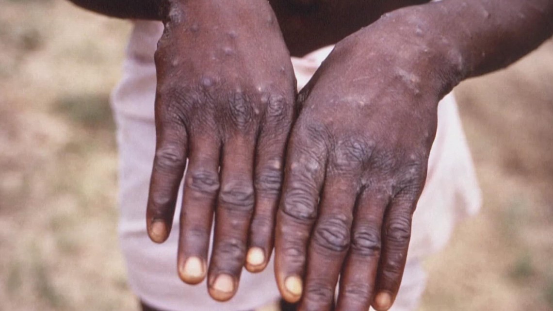 US officials announce 'aggressive' steps against monkeypox outbreak
