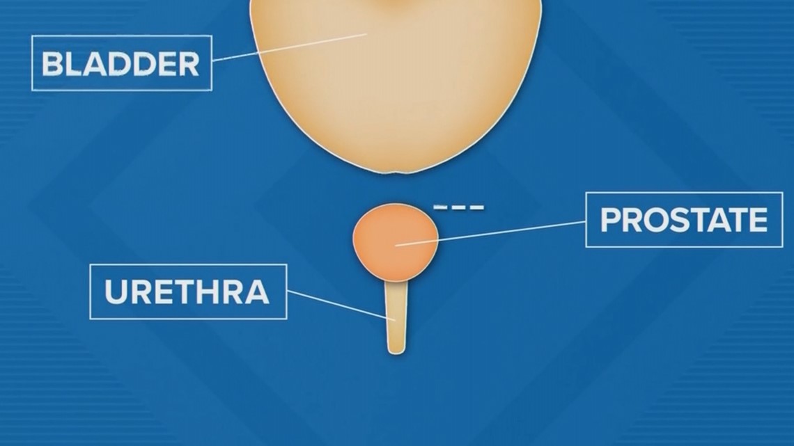 Treating prostate cancer | Wear the Gown | kens5.com