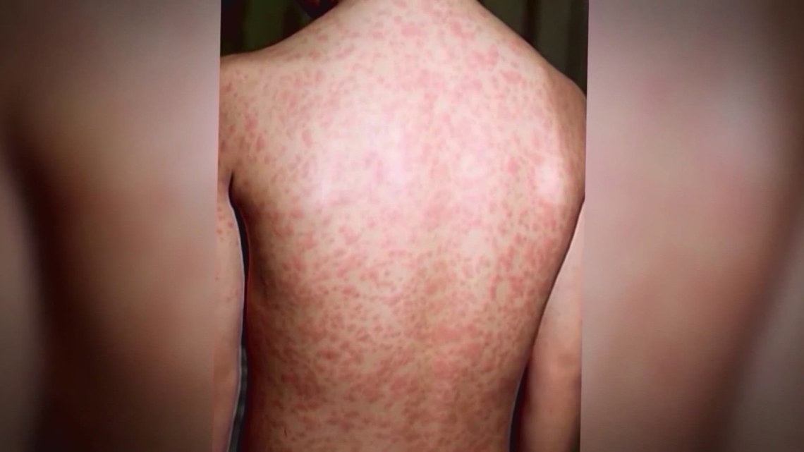 Measles cases rise to 146 in Texas; public health officials in SA set to give briefing