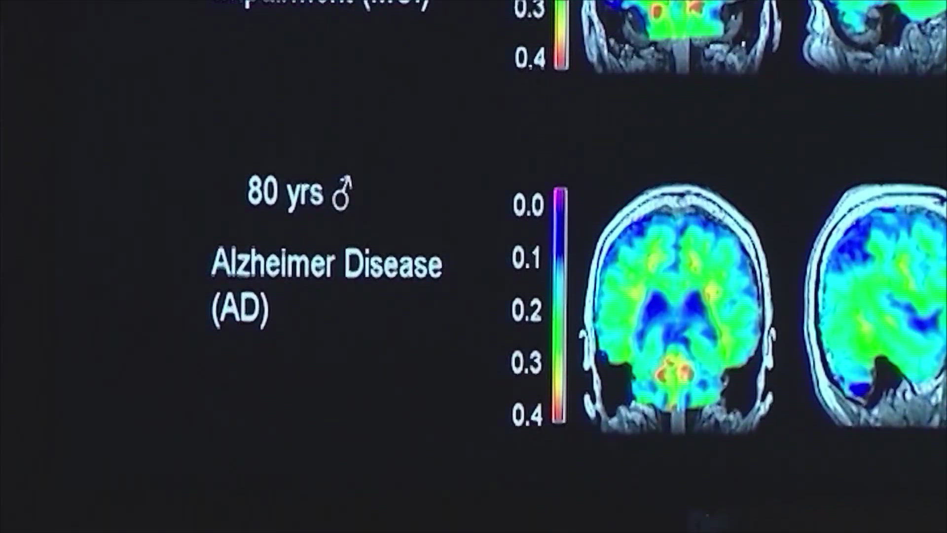 In a large trial, it slowed the decline of cognitive function overall about 22% over 18 months.