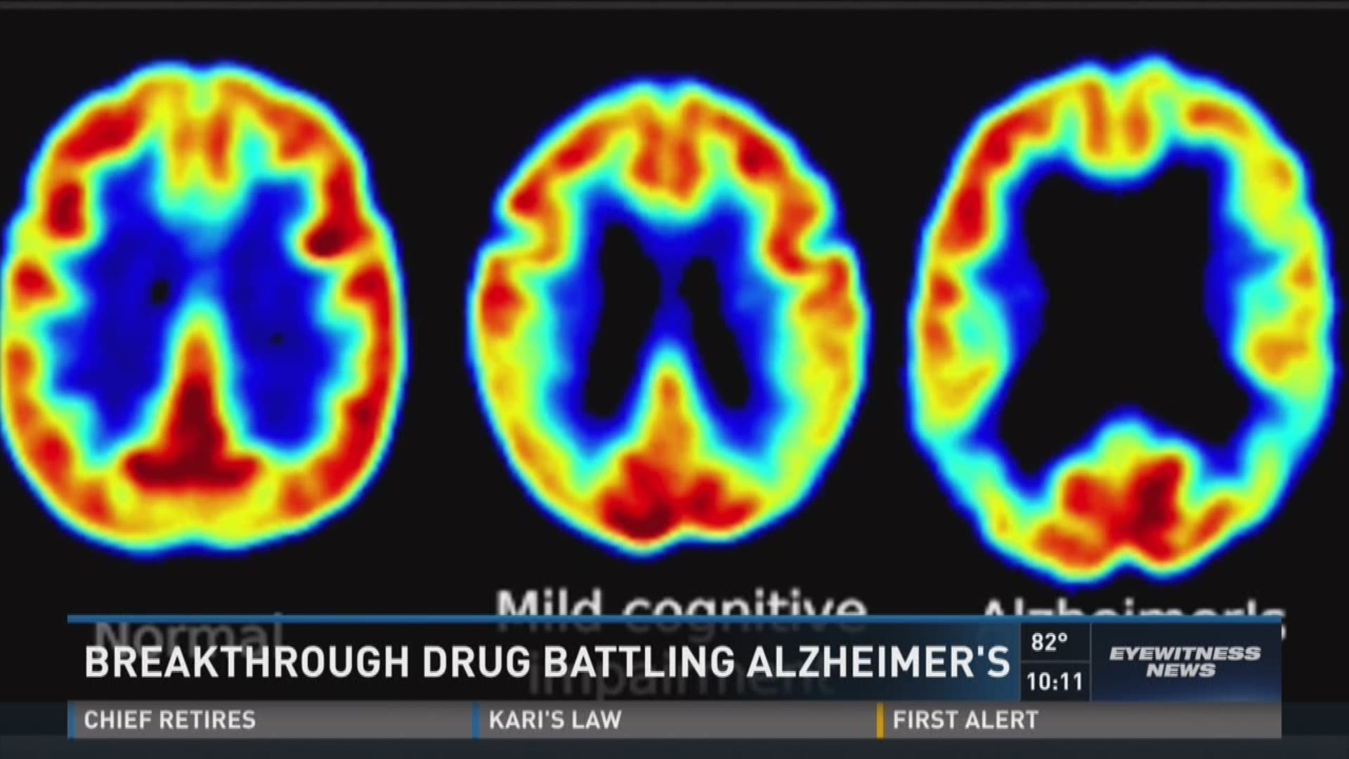 Breakthrough drug battling Alzheimer's