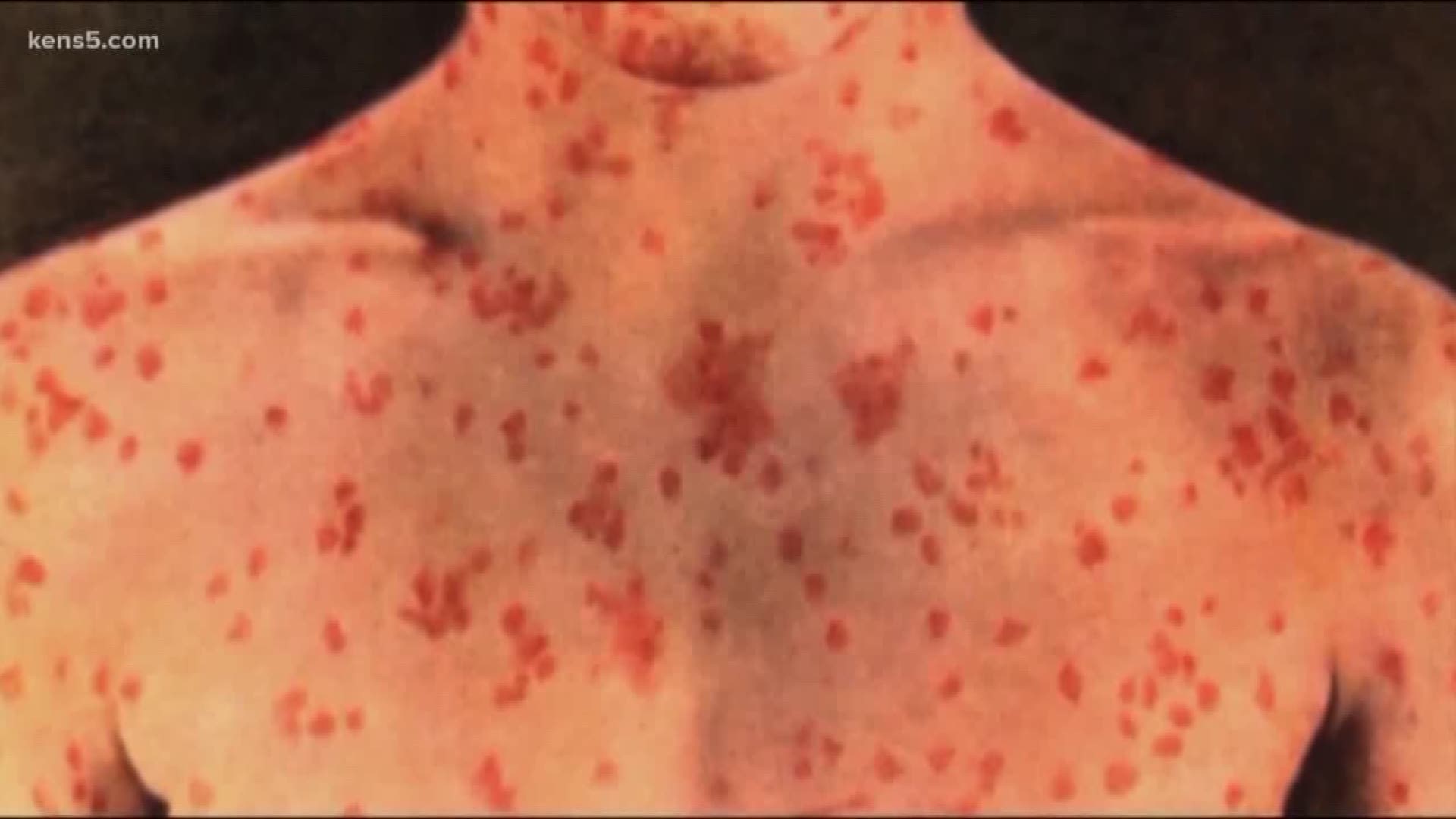 The San Antonio has its first diagnosis of the measles as the disease moves through several states, a University Health System spokesperson confirmed.