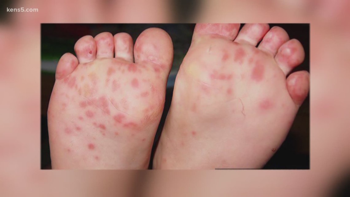 Contagious viral infection running rampant among children in San Antonio