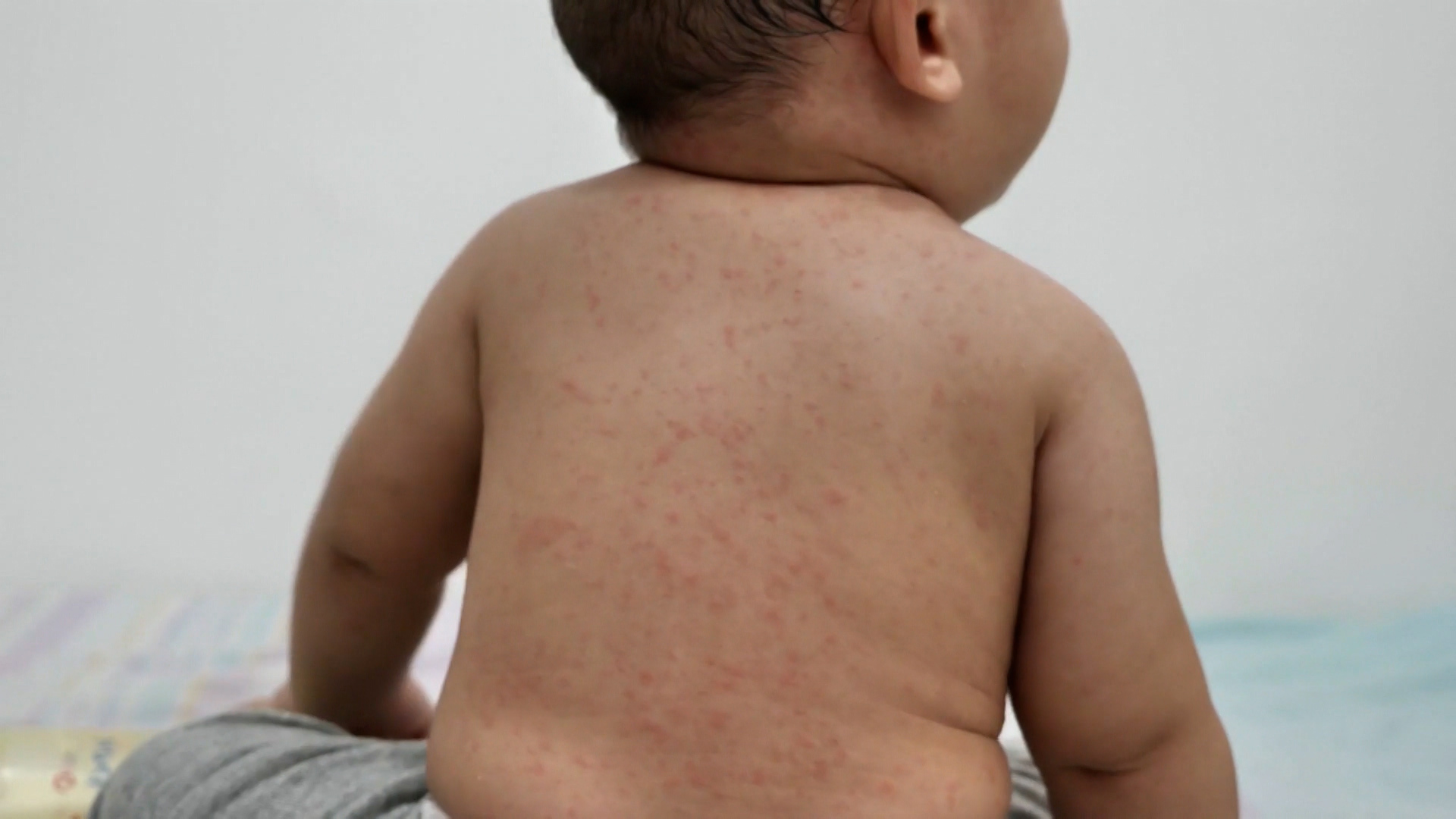 On this episode of Eye On Health, we discuss the recent measles outbreaks in the U.S., RFK Jr. talks about Autism, and more.