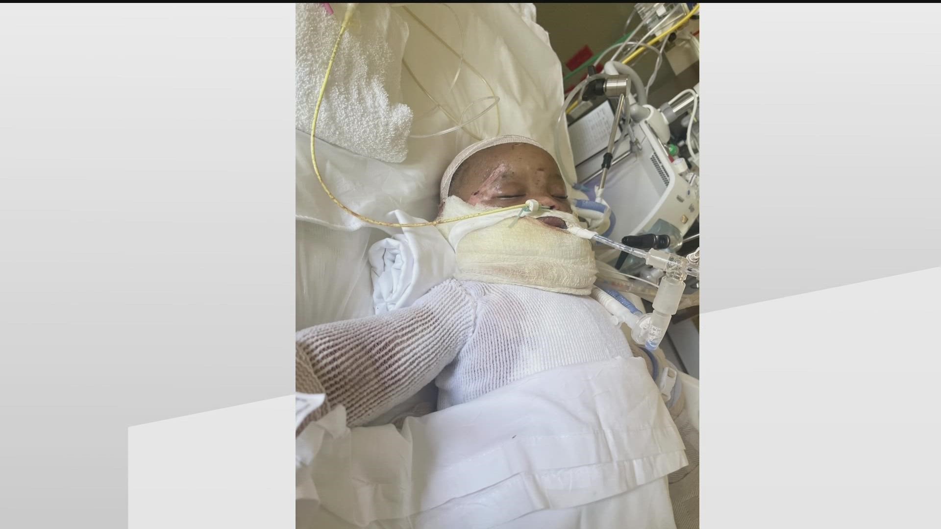 A freak accident left the Powder Springs child with burns on over 40% of his body.